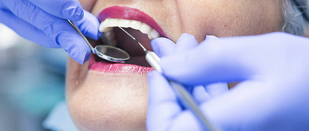 Best Teeth Whitening  in Lexington, WA